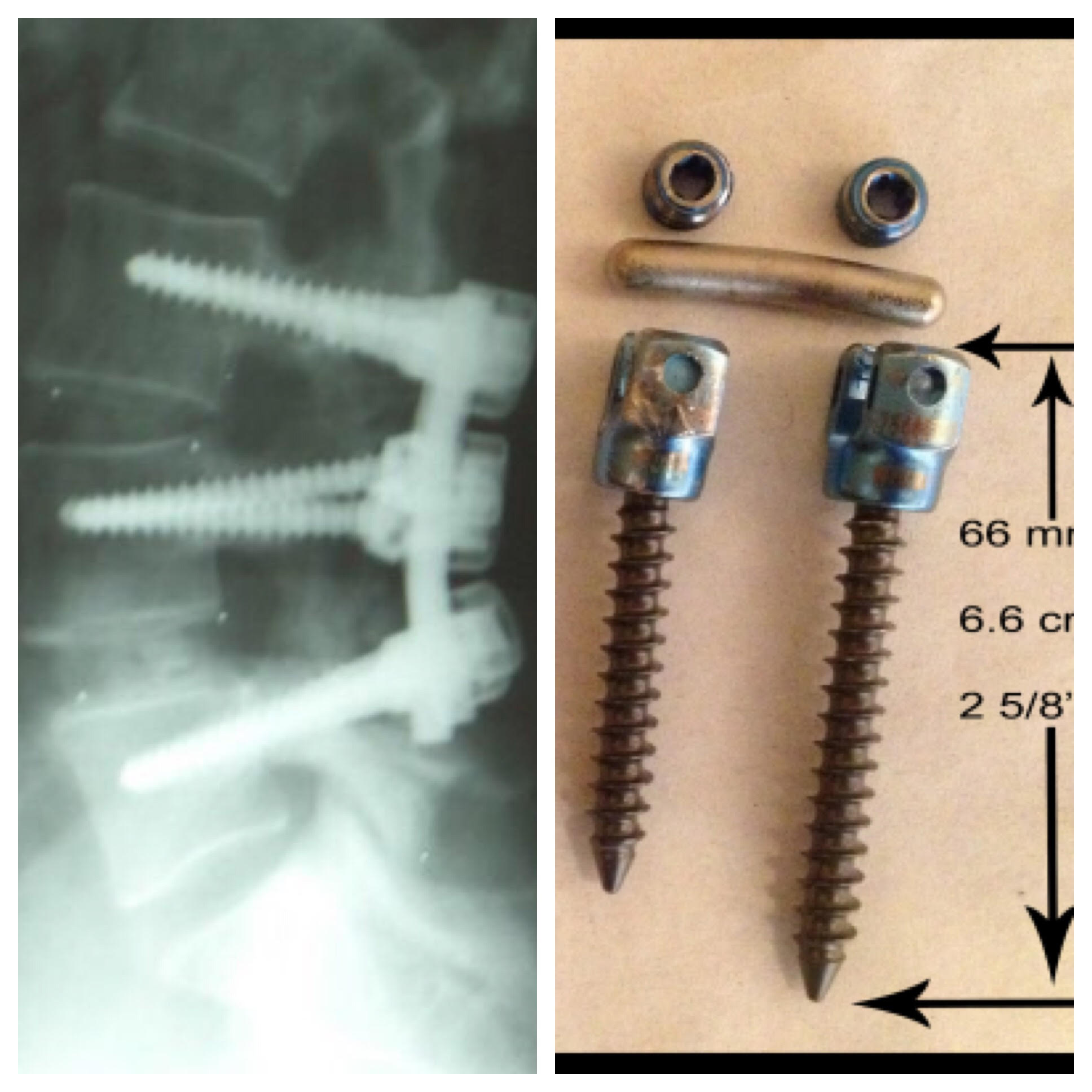Spinal surgery in The Villages