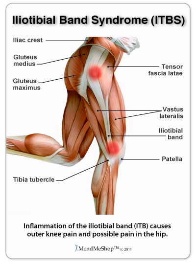 What is (ITBS) Iliotibial Band Syndrome - Legacy Clinic Chiropractic