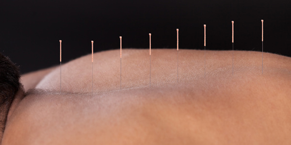 Reasons To Consider Dry Needling