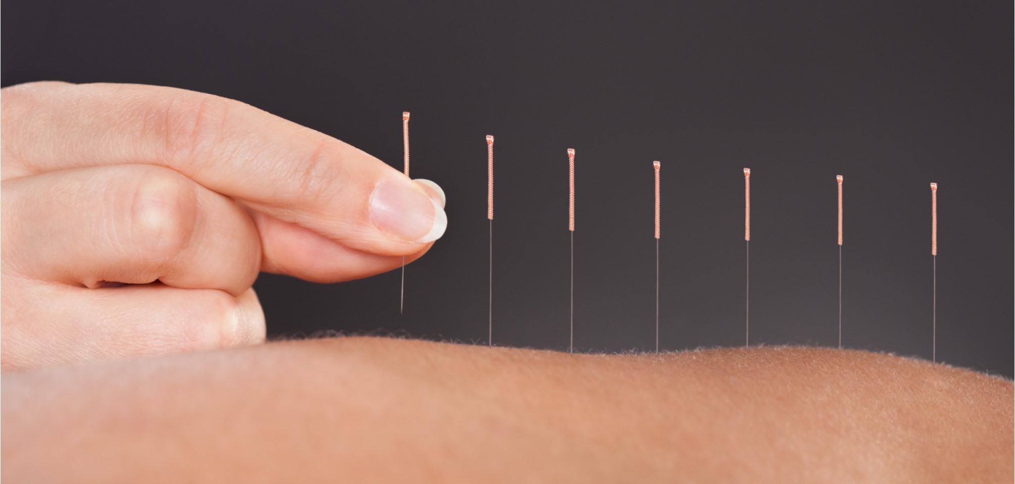 Acupuncture For Anxiety