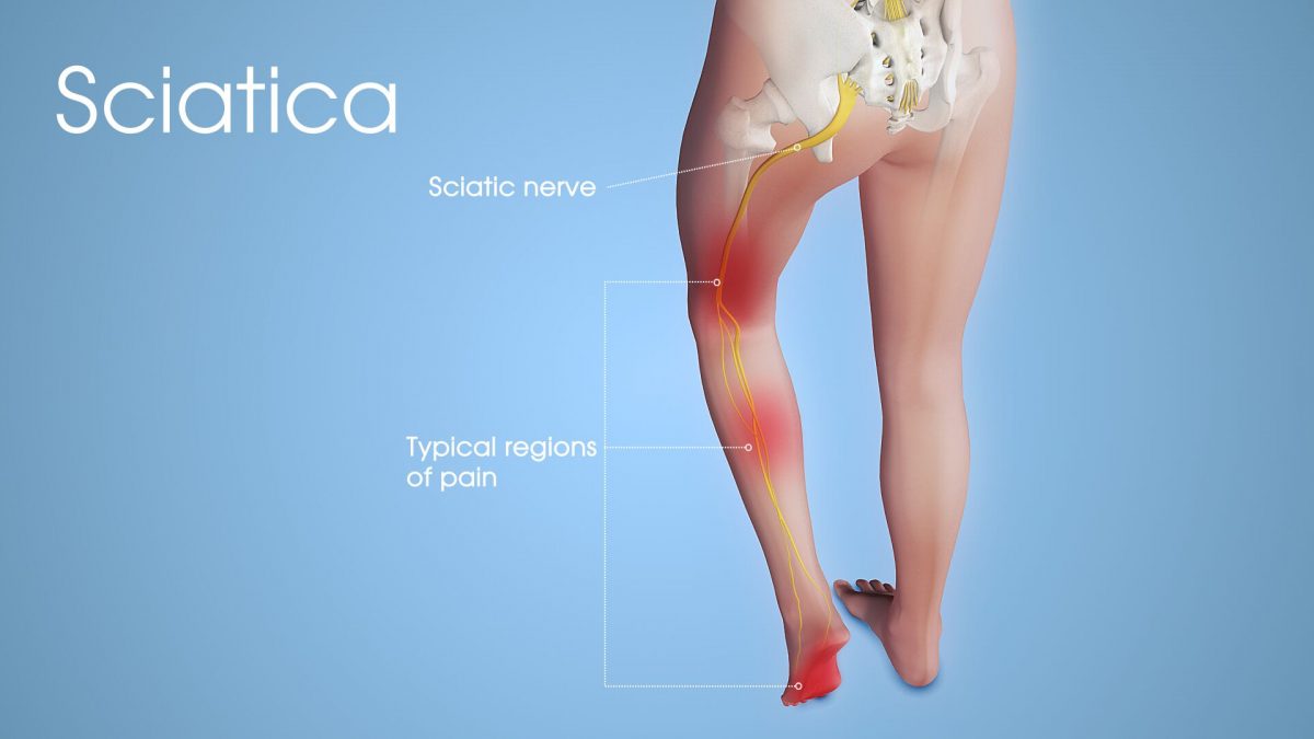 what is sciatica