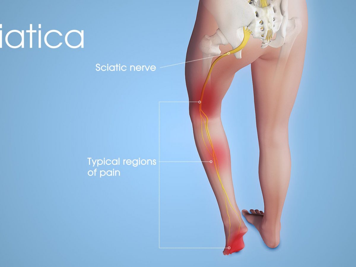 Get Therapy For Sciatic Nerve Pain
