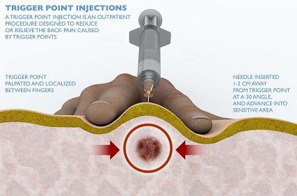What is a Acupoint injection? 