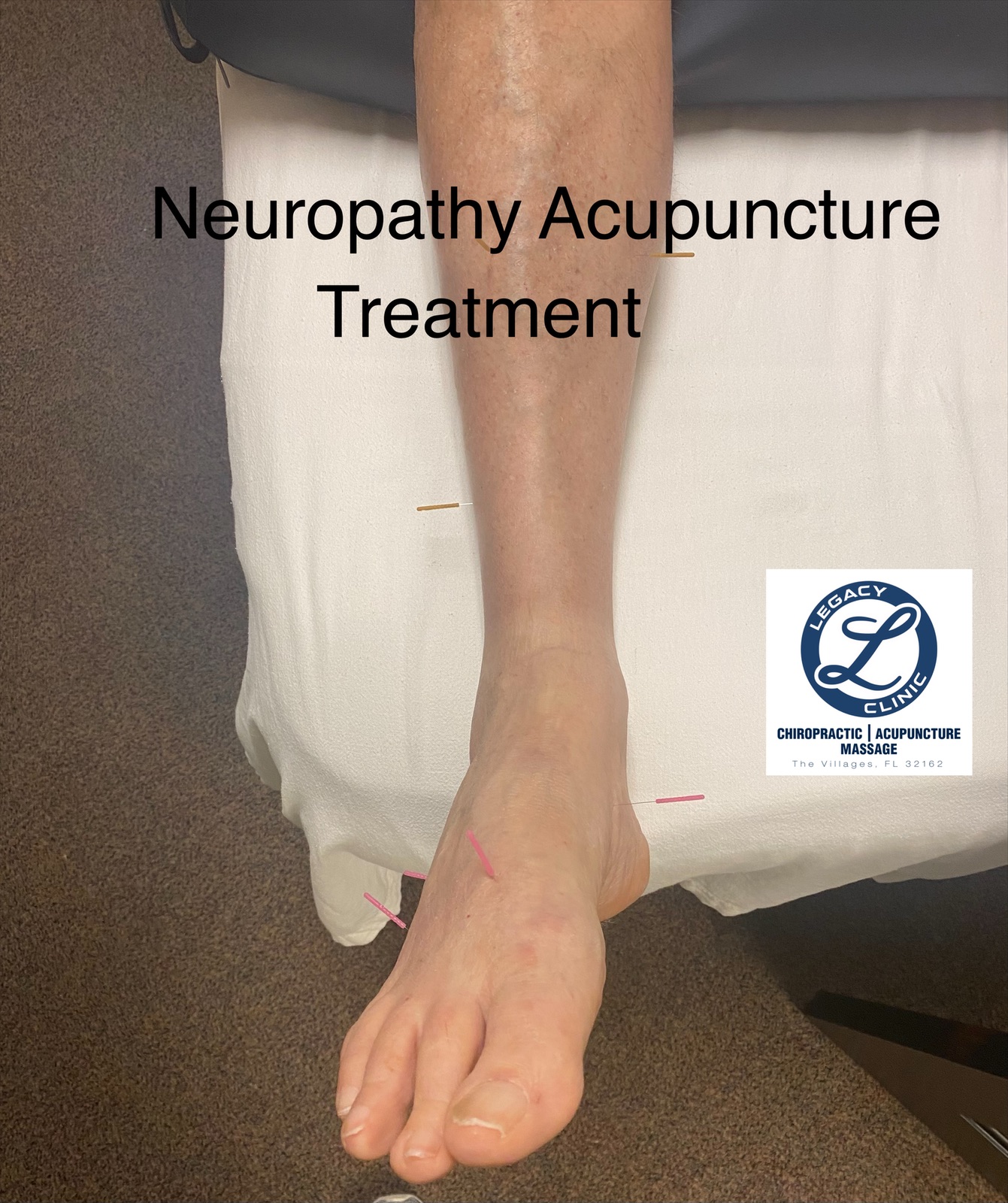 Acupuncture neuropathy
